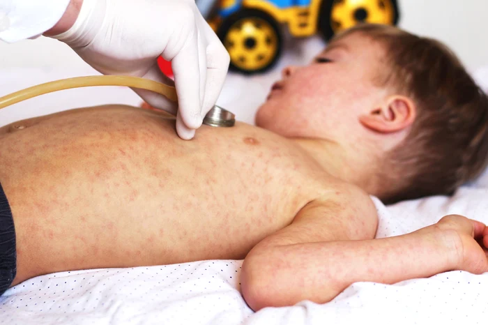 Child with measles
