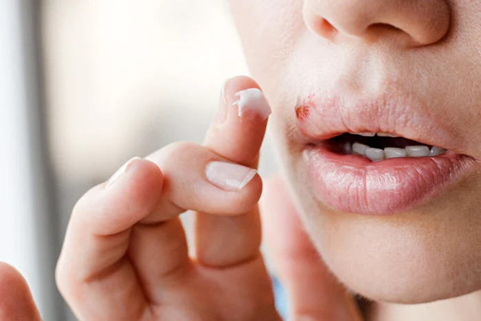 The image of a buccal herpes to a woman who applies a cream as a photo treatment actu.fr