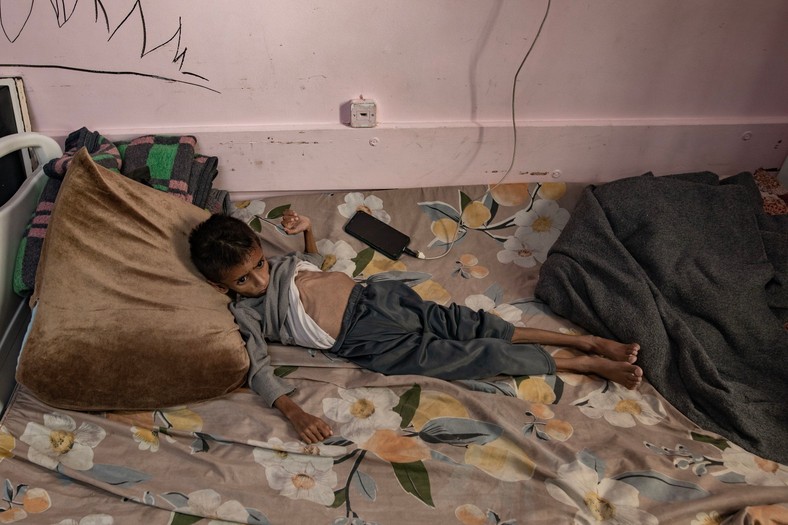 A five-year-old Palestinian boy of Osama al-rab, suffering from serious malnutrition, at the Nasser hospital in Khan Yunis, in the southern part of the Gaza Zone, May 26, 2025.