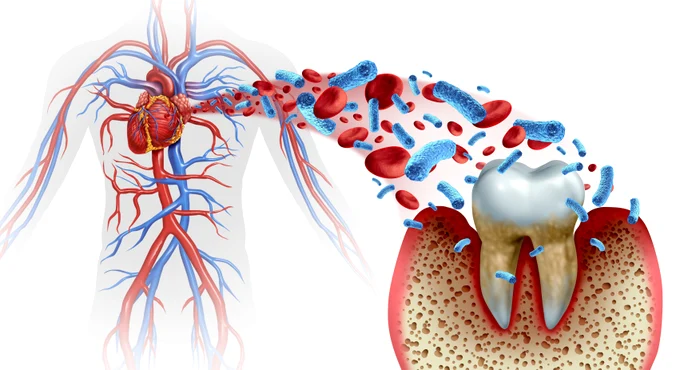Illustration showing the connection between periodontosis and cardiovascular disease shutterstock