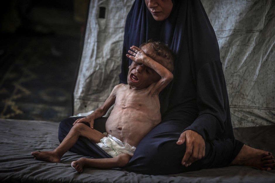 One and a half year old Muhammed Zakarja Ajub al-Matouk, one of thousands of children suffering from hunger and malnutrition in the Gaza Strip, July 24, 2025.