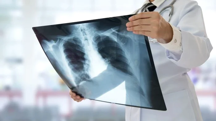 Cancer in Plămăni, detected in advanced stages Photo: Archive