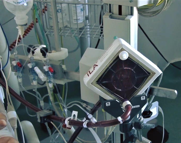The device allows to take over the functions of the lung/heart photo: FB/Hospital Victor Babeș Timișoara