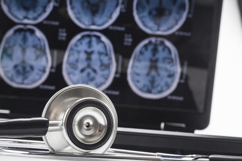 Alzheimer's disease, analyzed in the tomographs of some patients, photo: Felipe Caparros Cruz / Dreamstime.com
