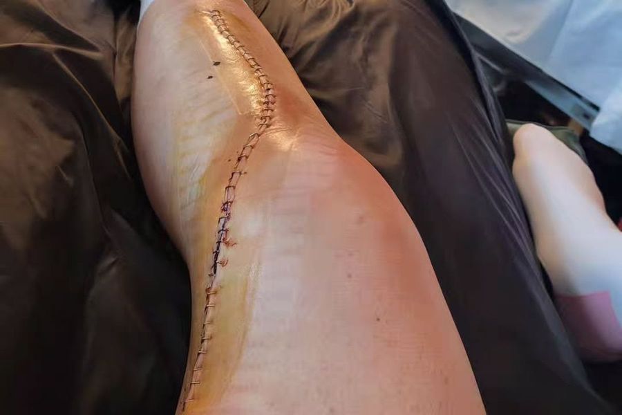 The terrible injury suffered in April still gives Federica Brignone's headaches: 