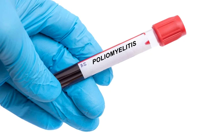 Poliomielita FOTO Shutterstock