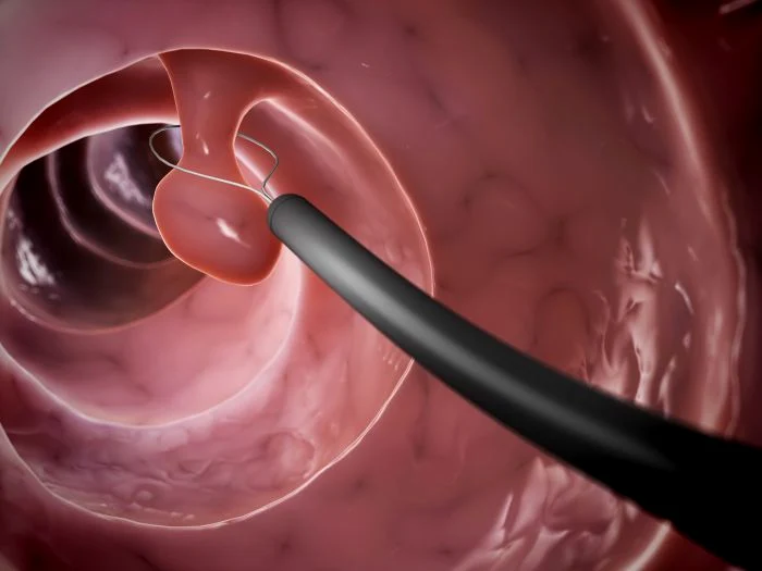 Colon polyps PHOTO: archive, the truth