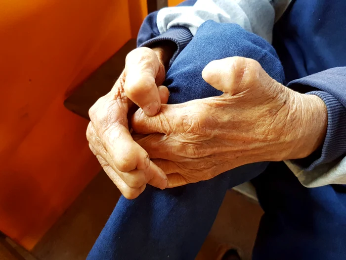 One case of leprosy has been confirmed and three more suspected cases are under investigation/PHOTO: Shutterstock