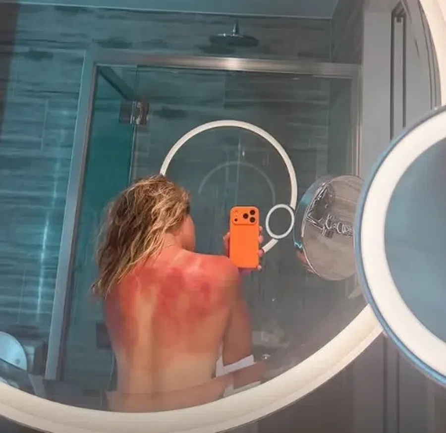 Severe burns before the Australian Open: 