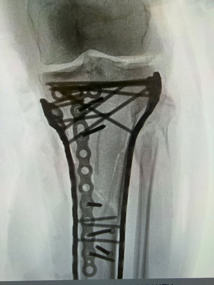 Lindsey Vonn's leg after surgery on February 20 // photo: Instagram