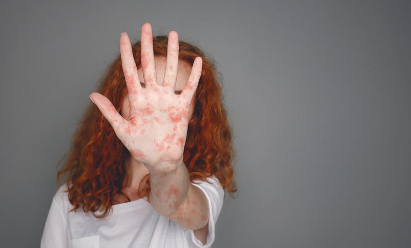 Measles, Photo: Prostockstudio | Dreamstime.com