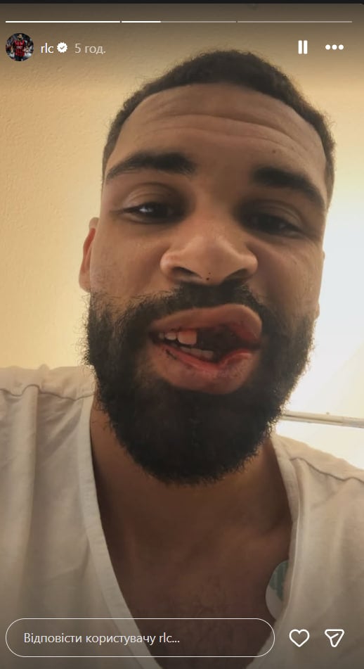Broken jaw, knocked out teeth and split lips. Star 