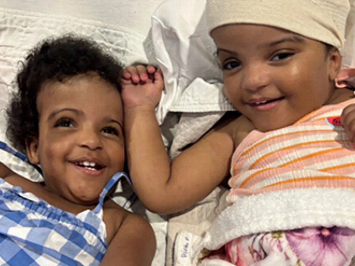 US Surgeons Successfully Separate Siamese Twins with Rare Condition — Siamese twins Hiab and Wuhbto, born with craniopag